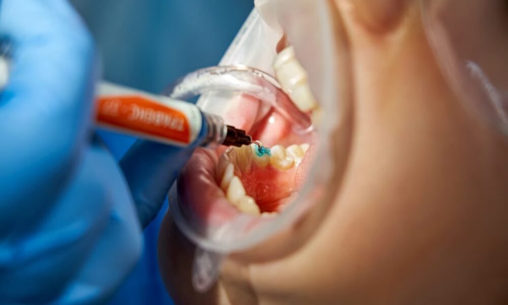 Dental Fillings