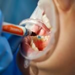 Dental Fillings