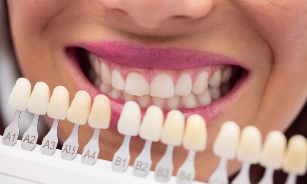 How Long Does Each Veneer Material Actually Last