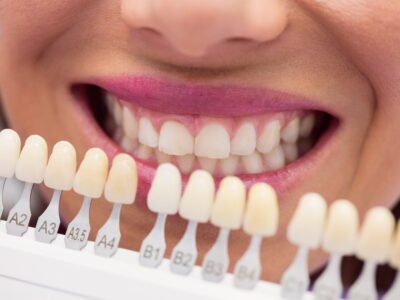 How Long Does Each Veneer Material Actually Last