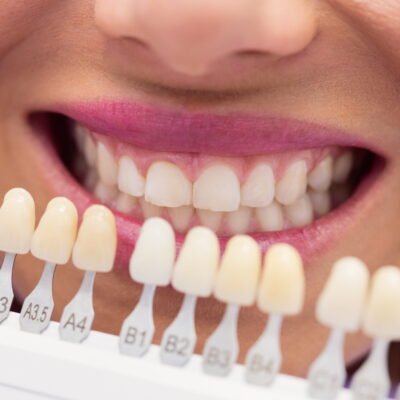 How Long Does Each Veneer Material Actually Last