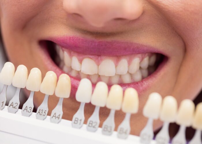 How Long Does Each Veneer Material Actually Last